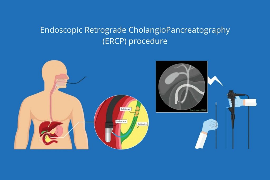 DIAGNOSTIC AND THERAPEUTIC ECRP PROCEDURE FOR BITE DUCT STORE AND